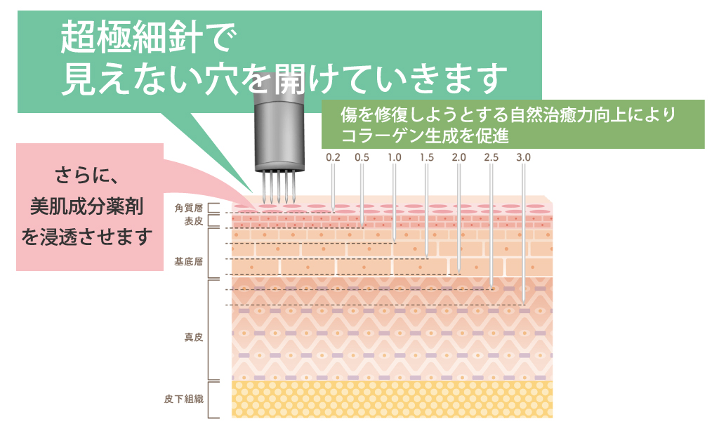 ダーマペンの仕組み