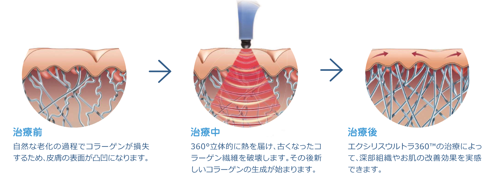 エクシリスウルトラ360